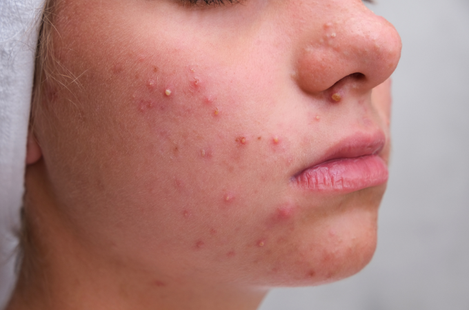 bagaimana rutinitas skincare untuk bruntusan di jidat 